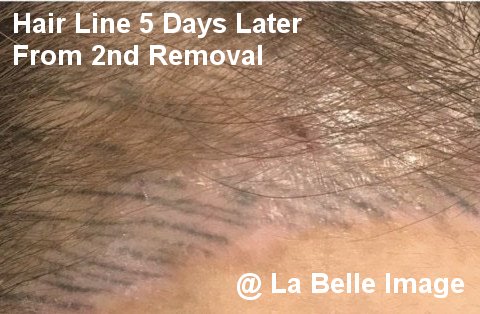 Hair Line Permanent Make Up 5 Days Later From 2st Removal